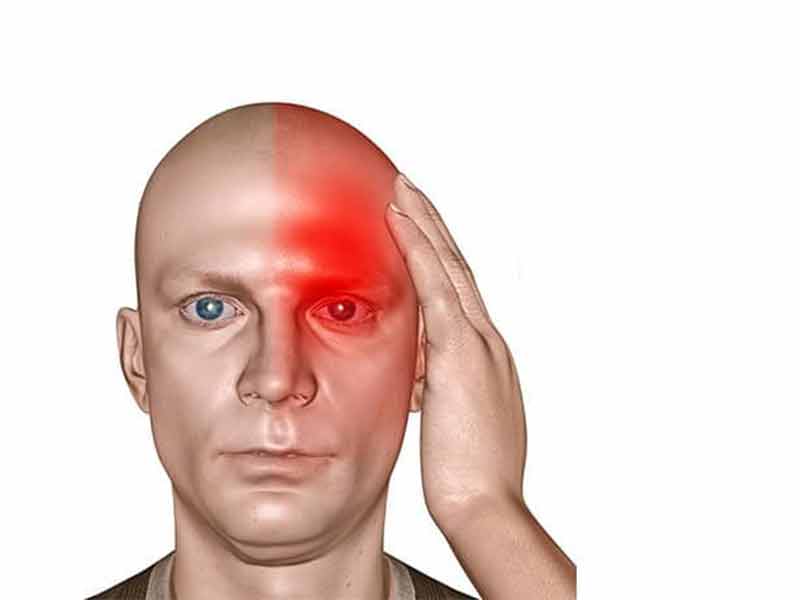 سر دردهای-میگرنی چیست؟